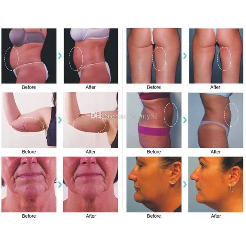 Best Sale 980nm 1470nm  Laser Lipolysis Laser Device  Liposuction Machine