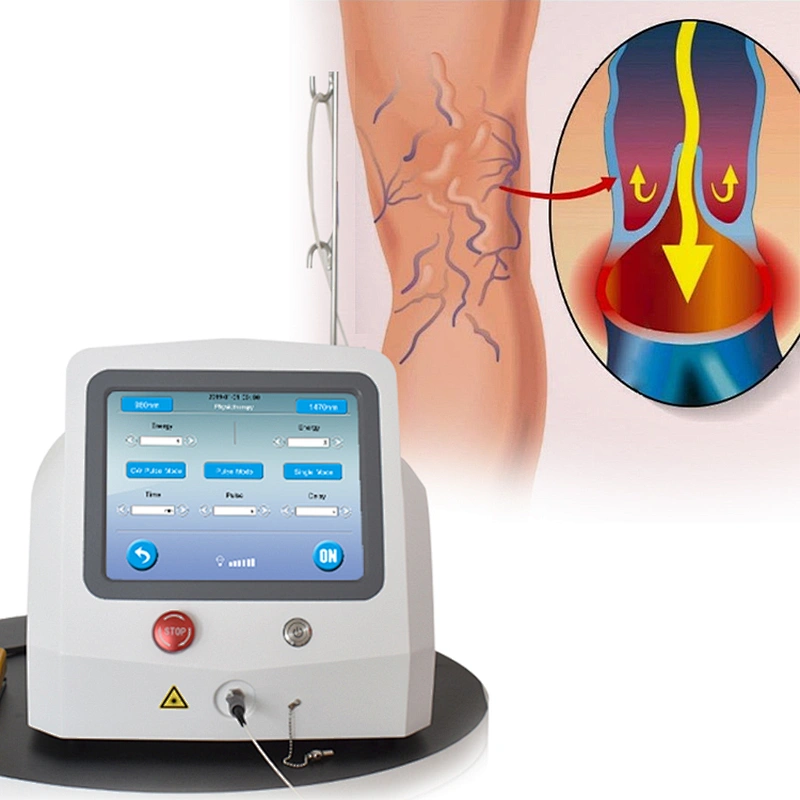 Minimally Invasive EVLT  Varicose Veins Laser 1470 nm  Ablation Therapy  Endovenous EndoLaser Vein Surgery Laser 1470nm