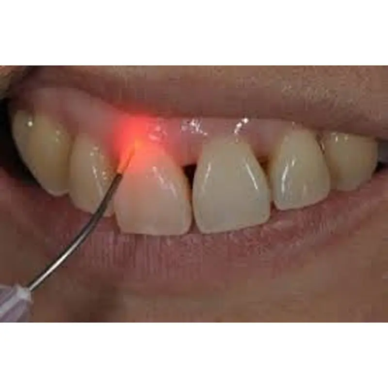 2024 Newest Big Power 980nm Diode Dental Laser Therapy Teeth Whitening Device