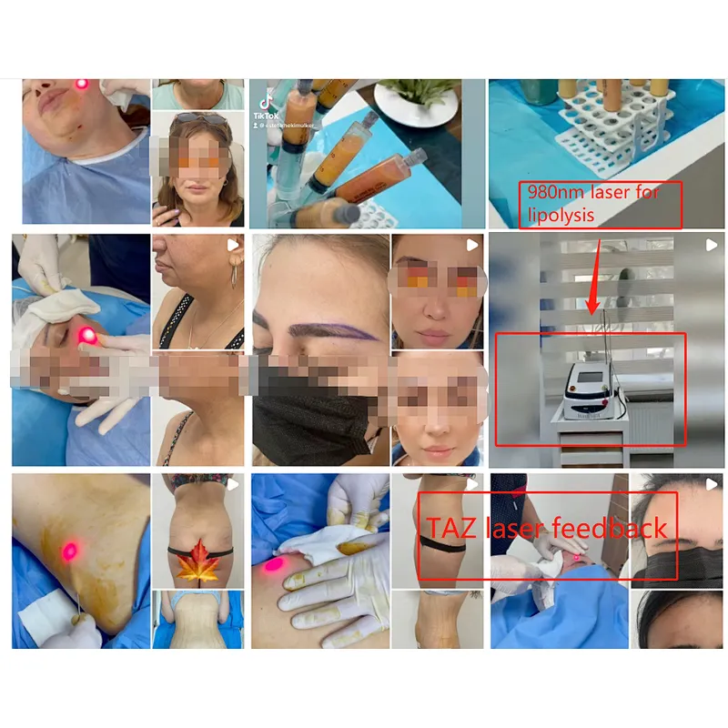 2023 Most Popular 980nm Facelift Bodycontouring Liposuction Lipolysis Machine