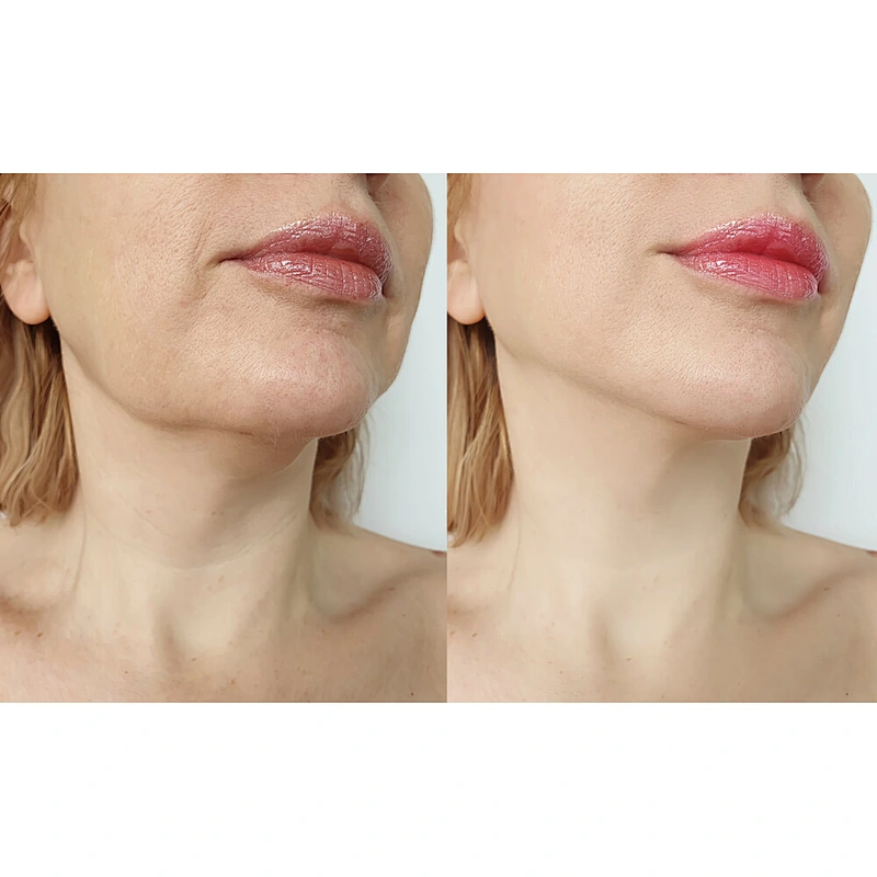 980nm 1470nm Laser Tightening Skin Retraction Improve Sagging Facial Care Skinrejuvenation