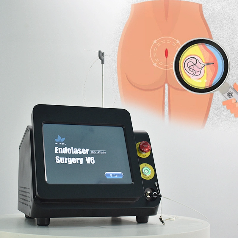Hemorrhoids removal 980nm 1470nm diode laser machine treatment of hemorrhoids fistulas