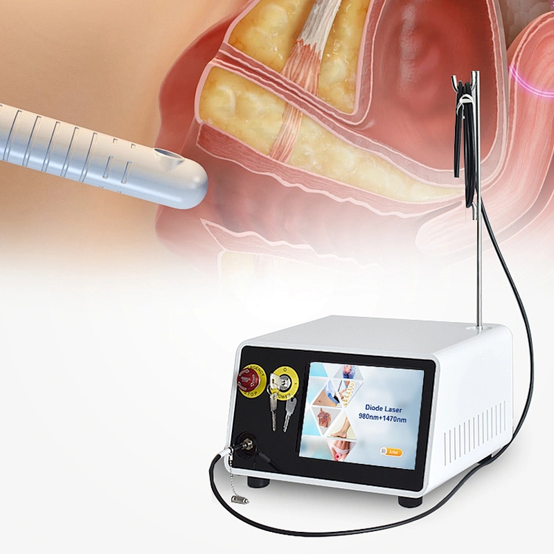 Minimally Invasive 980nm 1470nm Gynecology Machine Vaginal Laser for Vaginal Contraction