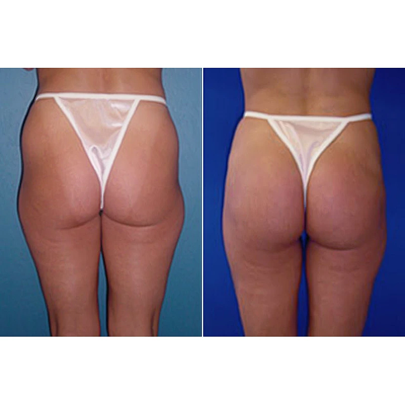Powerful 980nm Diode Laser Fiber Machine for Liposuction & Fat Burning 1470nm Laser for Body & Face Lifting CN Plug