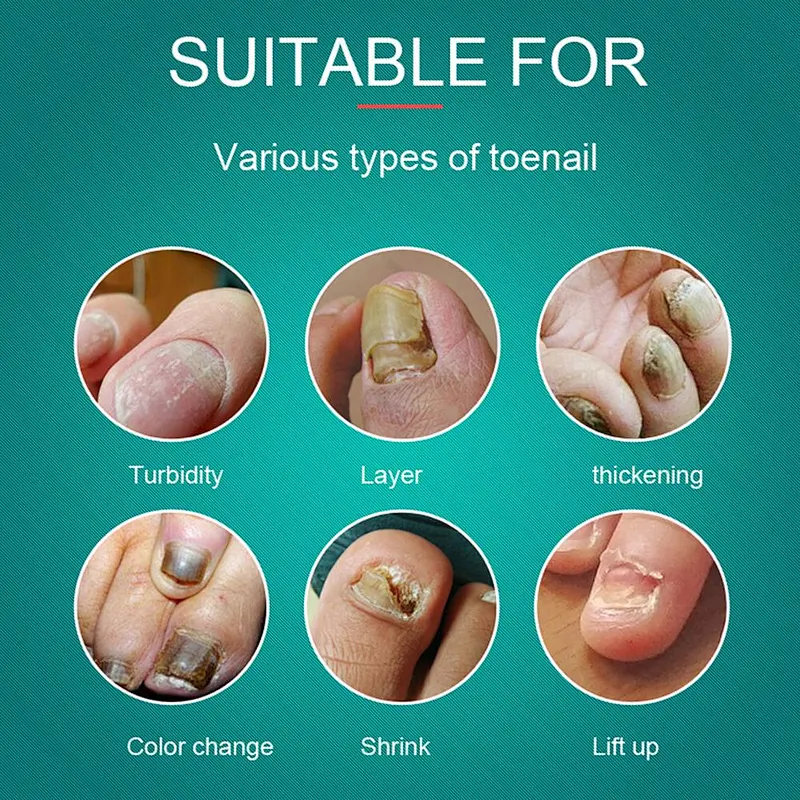 Triangel Laseev Podiatry Podiatrist Laser Diode Nail Fungus Treatment 980nm 1064nm Device