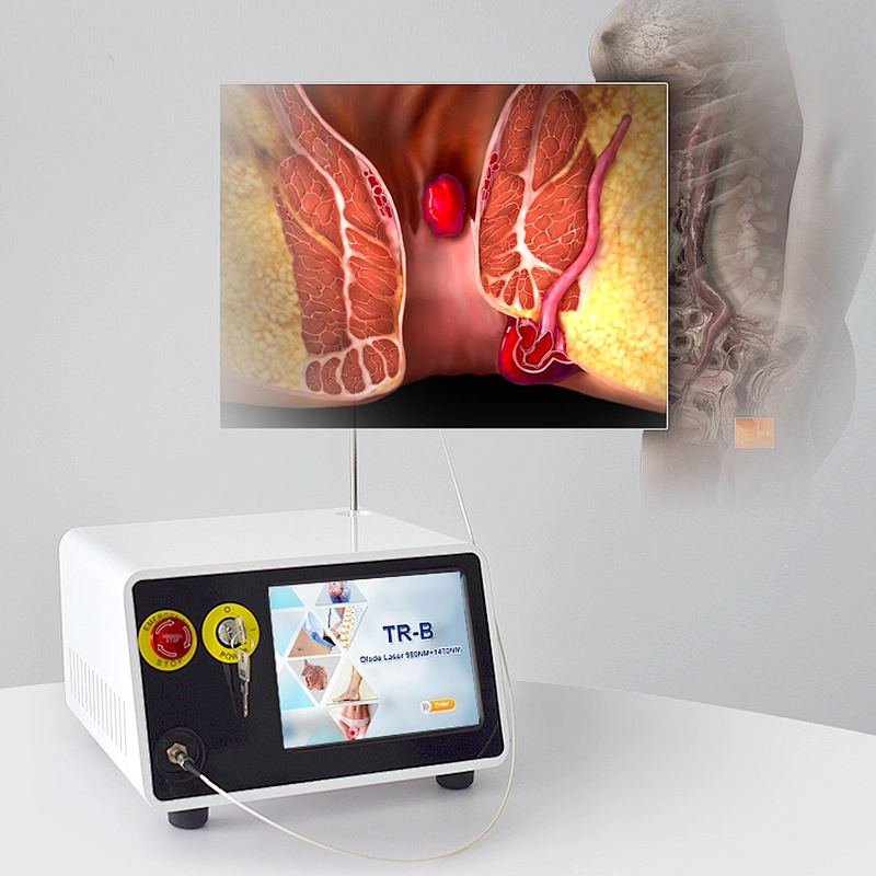 Hemorrhoids Treatment Surgery Diode Laser 1470nm With CE Hemorrhoids Laser Anal Fistula Hemorrhoids 980nm Laser