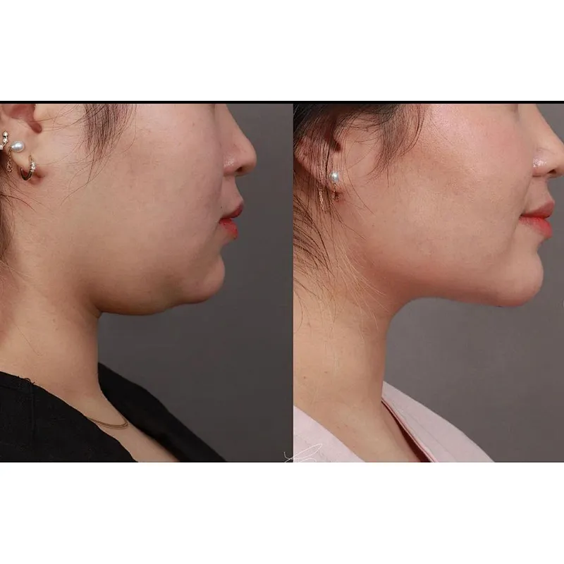 Latest Hot Sales  Diode Lipo Laser 980nm 1470nm  EndoSkin Face Lifting Laserlift EndoLaser Lipolysis Laser 1470nm