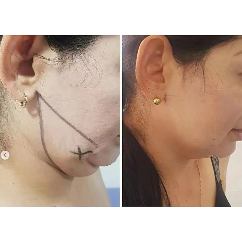 Professional Endolaser 980nm 1470nm Diode Laser Facial Lifting Machine/Lipolysis Body Shaping Slimming Machine