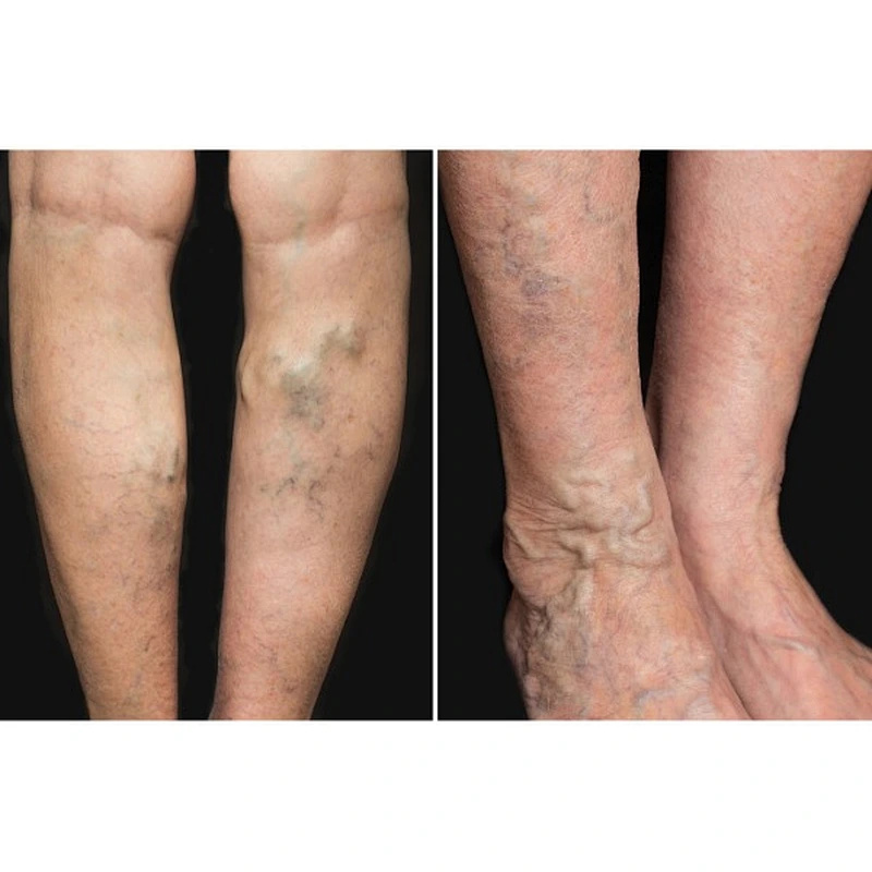 Diode Laser Ablation EVLT1470nm Endovenous Laser Varicose Vein Treatment Device/Spider Veins Vascular Removal Machine
