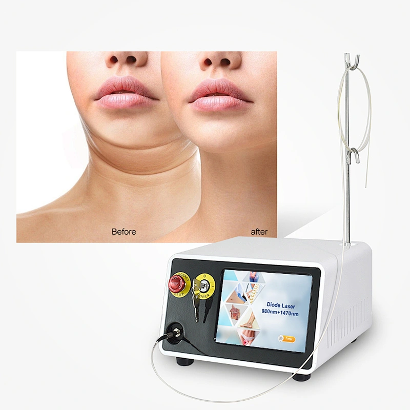 Surgery Plastic 980nm 1470nm 30W 17W Laser Endoskin Laser Lipolysis Machine