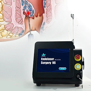 Diode Laser Dual 980nm 1470nm Hemorrhoidectomy Laser for Proctologist/Proctology