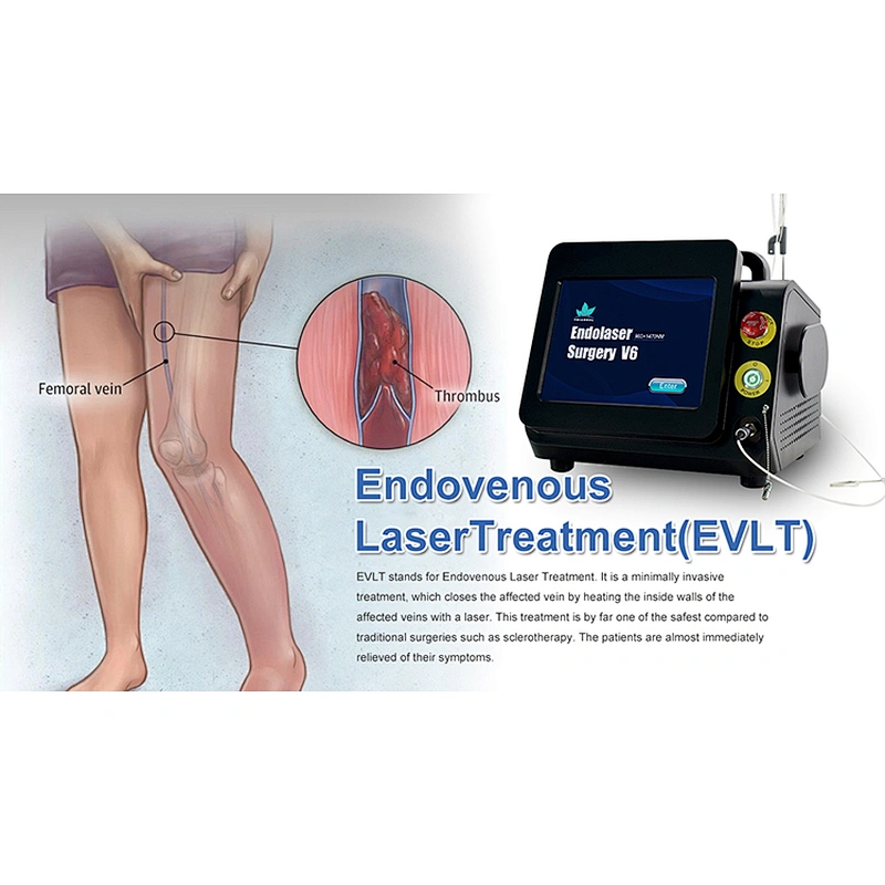 Dual Wave 980nm Class Iv Surgical Laser Equipment for Varices Des Membres Inferieurs Varicose Veins Evlt  Evla Varice