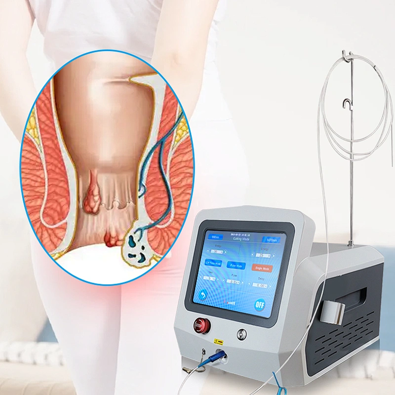 High Quality Hemorrhoids 980nm 1470nm Laser Machine 47w Mini-invasive Treatment for Hemorrhoids Fistula