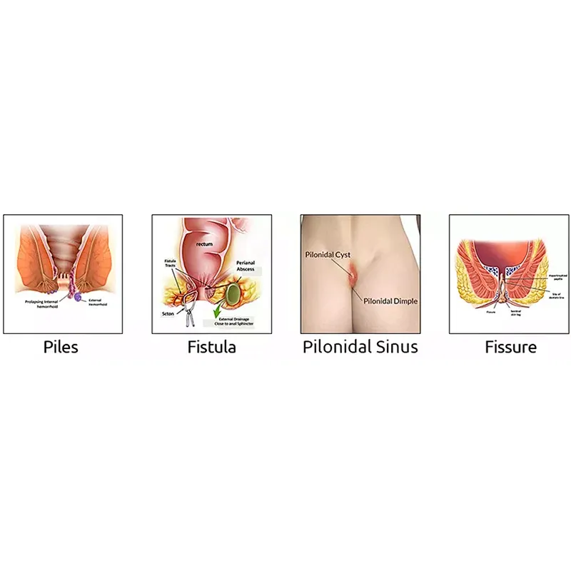 High Quality Hemorrhoids 980nm 1470nm Laser Machine 47w Mini-invasive Treatment for Hemorrhoids Fistula