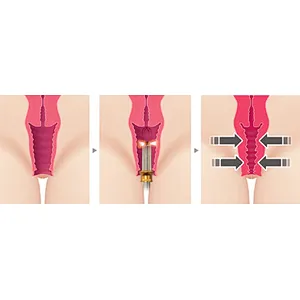 Portable Gynecology Vaginal Tightening Surgery Laser System Vaginal Rejuvenation Laser Machine