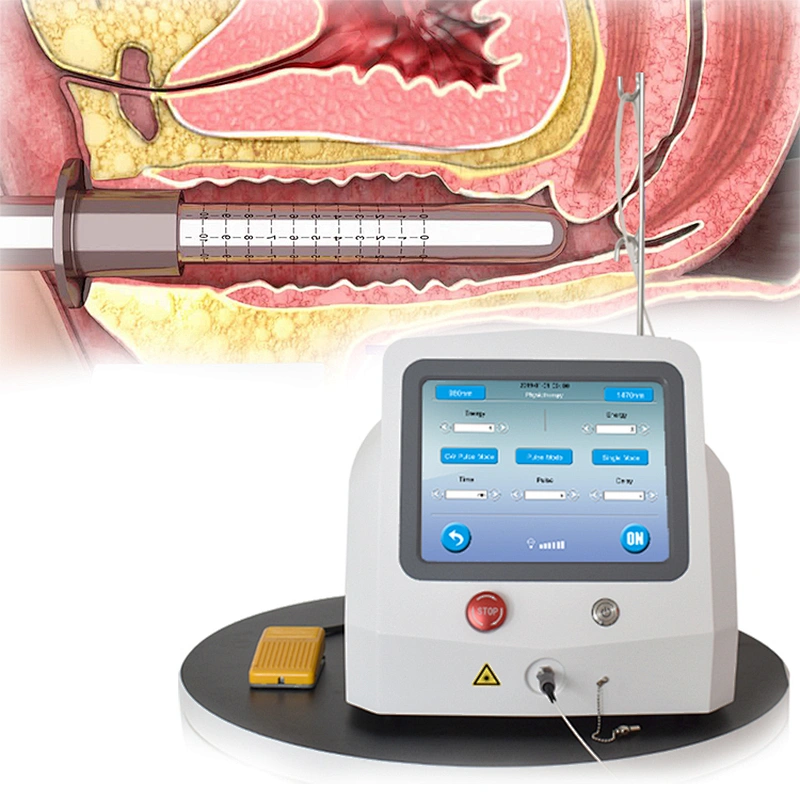 Top Sale Germany Tech Hospital Clinical Cosmetic Gynecology Surgery 980nm 1470nm Laser