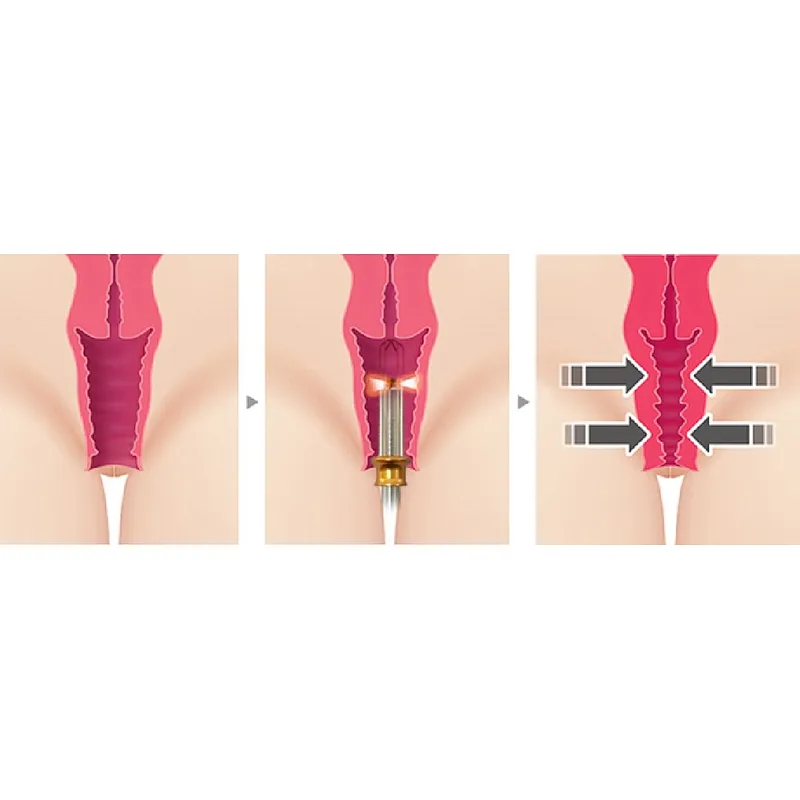 Newest  Gynecology Laser Therapy Device Laser Rejuvenecimiento Vaginal Diode Laser 980nm 1470nm