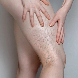 China Factory Best Price 1470nm Diode Laser Machine Vascular Removal Varicose Vein Treatment Device