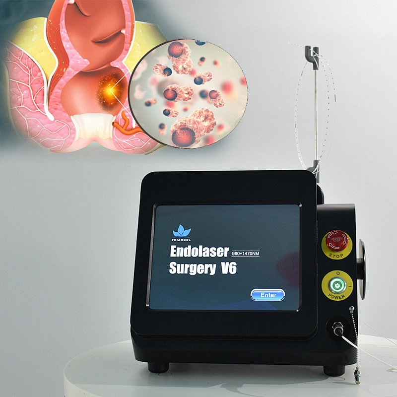 980nm1470nm Minimally Invasive Proctology Treatment Device Diode Laser Removal Hemorrhoids & Anal Fistula