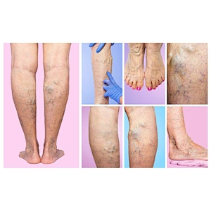 4 in 1 980nm Laser Spider Vein Diodo Laser Endovascular Laser Endovenous Machine Radiofrequency Varicose Veins Removal Machine