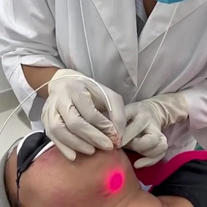 Triangel Diode Laser Lipolysis 980nm Medical Liposuction Machine Remove Eye Wrinkles and Facial Lifting/firming the Jawline