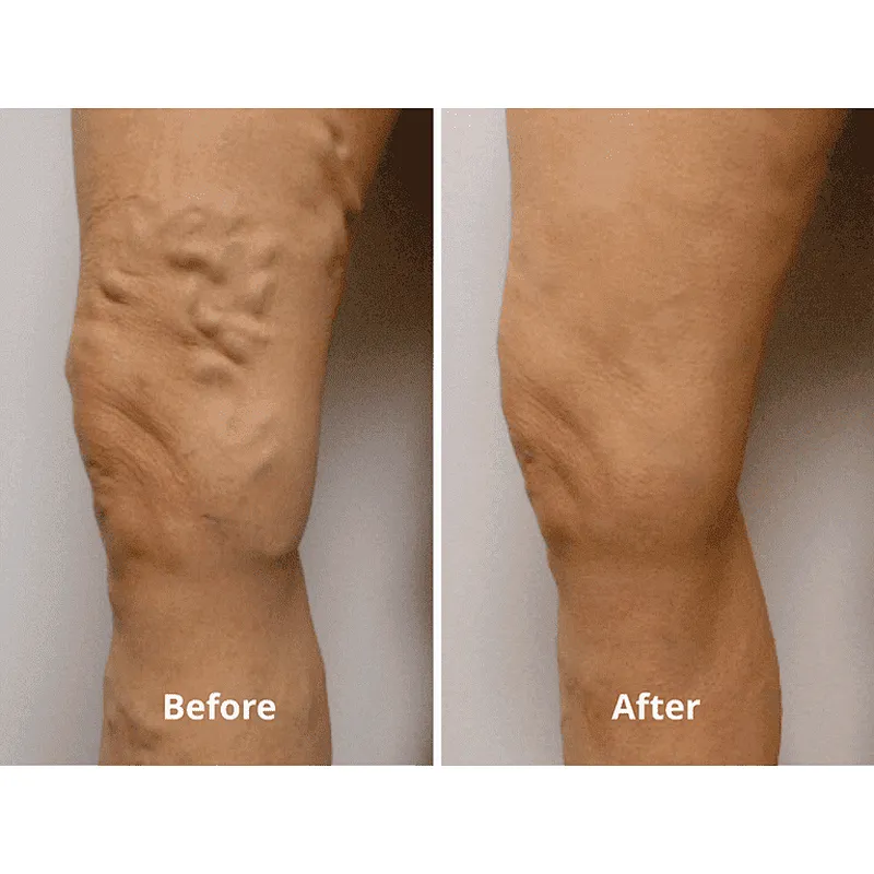 Laser Evlt Vascular Surgeon 1470nm EVLT Treatment EVLA Laser Legs Care Varicose