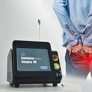 980nm 1470nm  pilonidal sinus diode laser proctology haemorrhoids 1470nm Piles Proctology hemorrhoid diode laser