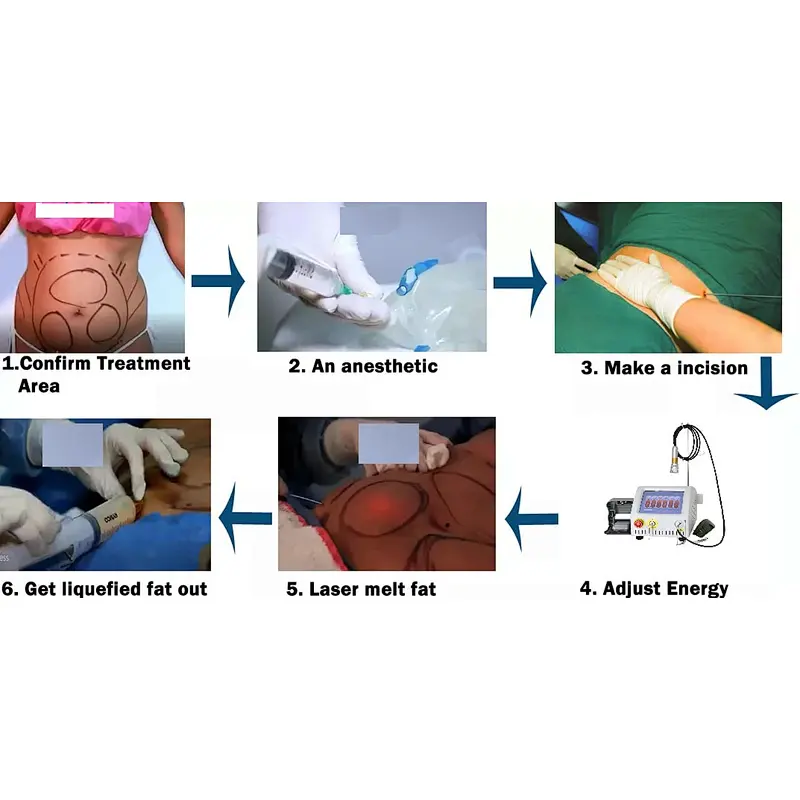 Hot Selling Triangel Minimal Invasive Plastic Surgery  Body Shaping  Liposuction Equipment for Fat