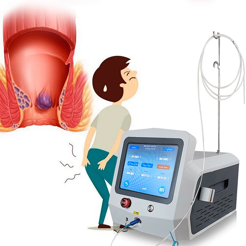 Hot Sale 980nm1470nm Proctology Diode Laser Hemorrhoids(HeLP Procedure) Surgery Machine Treatment Anal Fistula