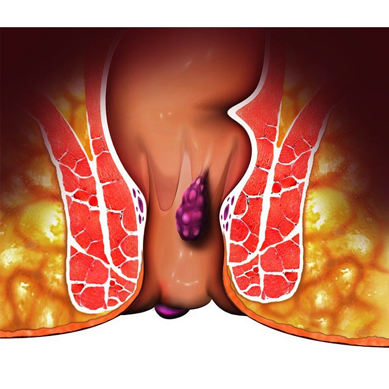 980nm 1470nm  Hemorrhoid Removal Laser  Machine Anal Fistula Haemorrhoids Laser Treatment