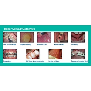 Three Wavelength Diode Dental Soft Tissue Laser Oral Treatment Teeth Whitening