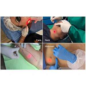 980nm 1470nm Surgical Laser Instrument Lipolysis Fat Reduction Equipment Cannula Micro Fiber Laser
