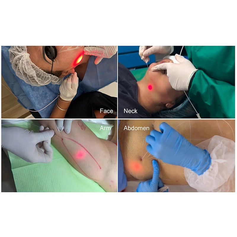 980nm 1470nm Surgical Laser Instrument Lipolysis Fat Reduction Equipment Cannula Micro Fiber Laser