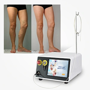 High Quality Portable 980nm 1470nm Diode Laser Varicose Veins Laser Treatment Machine