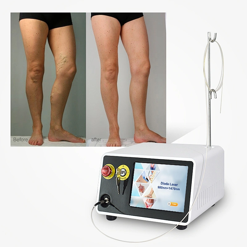High Quality Portable 980nm 1470nm Diode Laser Varicose Veins Laser Treatment Machine