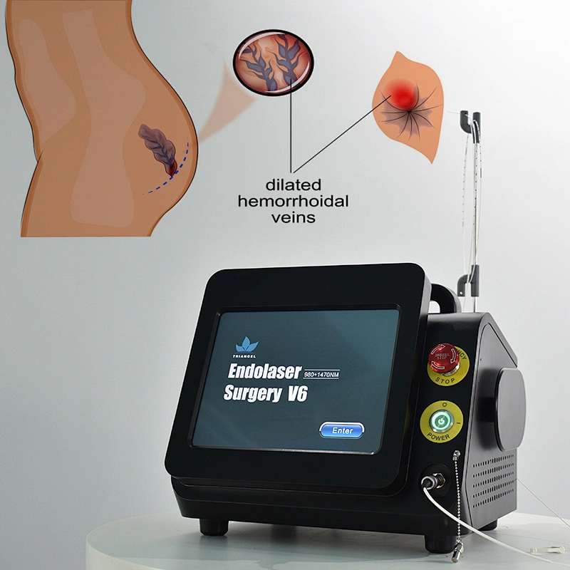 980nm1470nm Proctology Surgical Treatment Machine High Power Removal Fistula Hemorrhoids Pilonidal Sinus