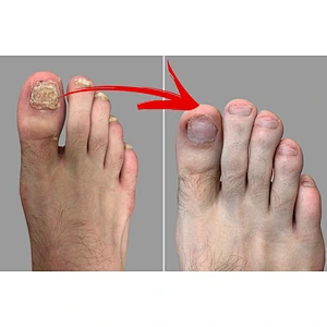 Class IV Laser 980nm  Podiatry Laser for Nail Fungus Onychomycosis Laser Toe Nail Fungus Treatment Machine