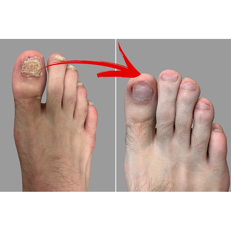 Class IV Laser 980nm  Podiatry Laser for Nail Fungus Onychomycosis Laser Toe Nail Fungus Treatment Machine