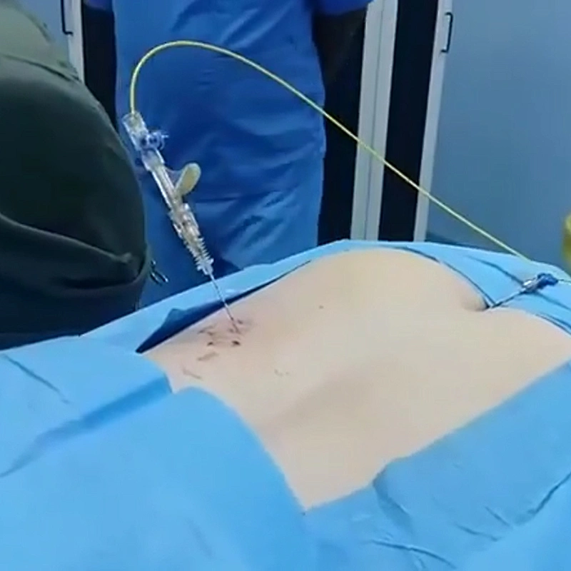 2024 Innovative Portable Diode 980 1470 nm Laser for PLDD Laser Treatment