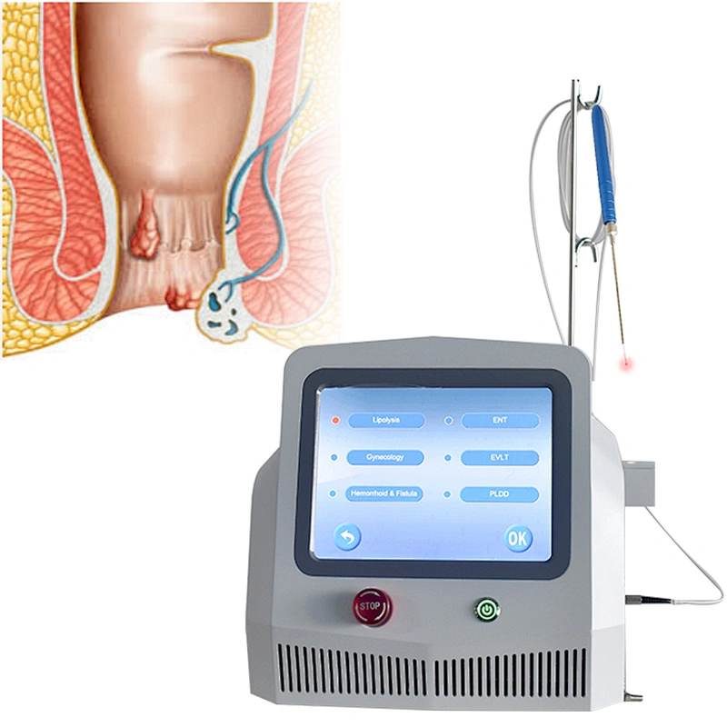 Hospital Clinical Surgery Proctology Machine Treatment Hemorrhoid Anal Fistula Hemorrhoids 980nm1470nm Diode Laser Removal