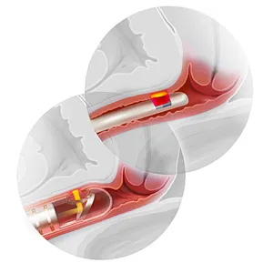 980nm1470nm Diode Laser Minimally Invasive Gynecological Instruments Use for Vaginal Tightening and Vaginal Rejuvenation