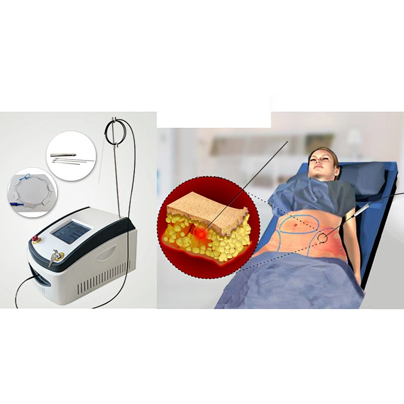 2025 Hot Sale 980nm Liposuction Sculpting Fat Reduction Device Liposuction Plastic Surgery Beauty Machine