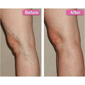 Varicose Veins Laser Treatment Machine 980nm Diode Laser 1470nm Removal Varicose Vein Device