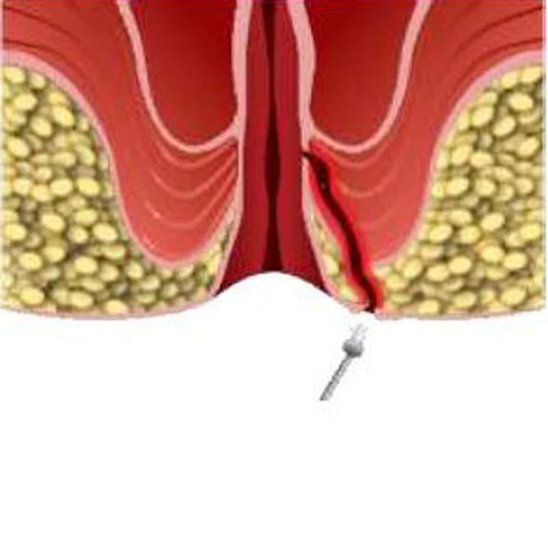 Anal Fistula Hemorrhoids Diode Laser 1940nm 1470nm 980nm Hemorrhoids Treatment Machine
