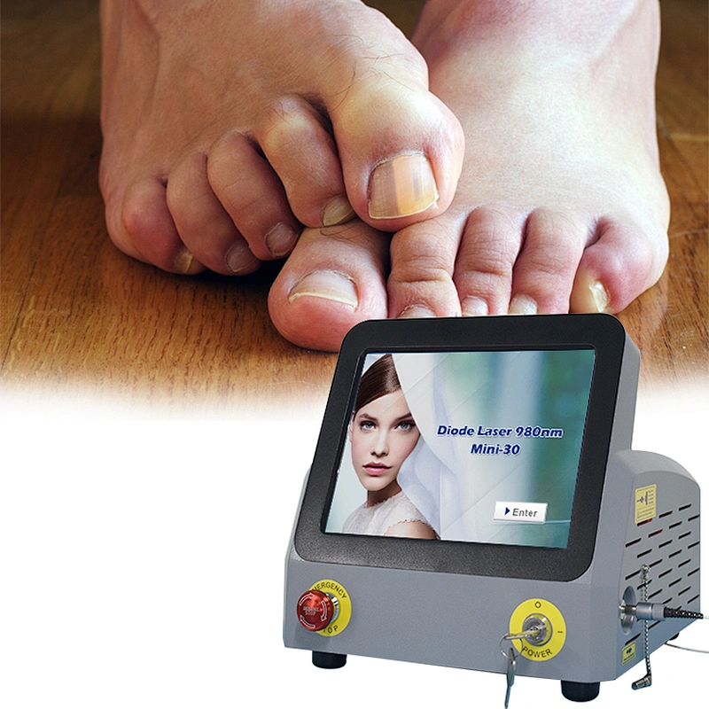 Portable High Power 980nm 30W Diode Laser Remove Nail Fungus Podiatry Onychomycosis Treatment Machine