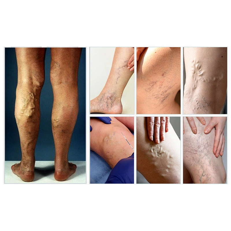 Triangel 1470nm Varicose Veins Laser EVLT EVLA Laser Machine