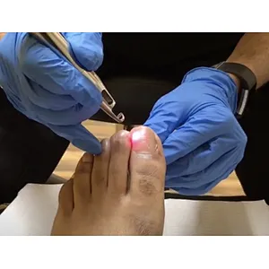 2024 Aesthetic Surgery 30w Podiatry Laser Treatment Machine 980nm Diode Laser Nail Fungus Treatment Device