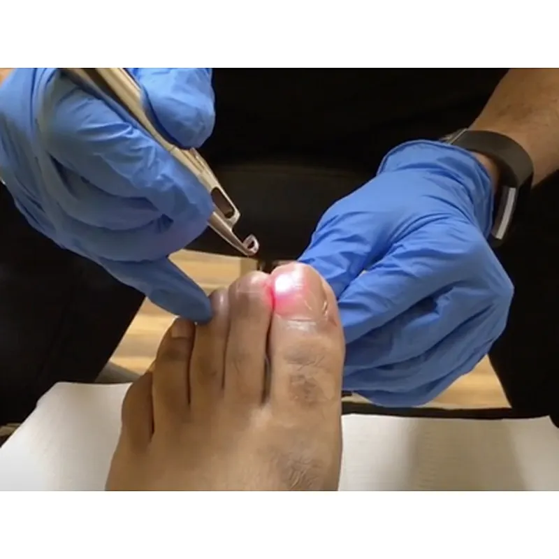 2024 Aesthetic Surgery 30w Podiatry Laser Treatment Machine 980nm Diode Laser Nail Fungus Treatment Device