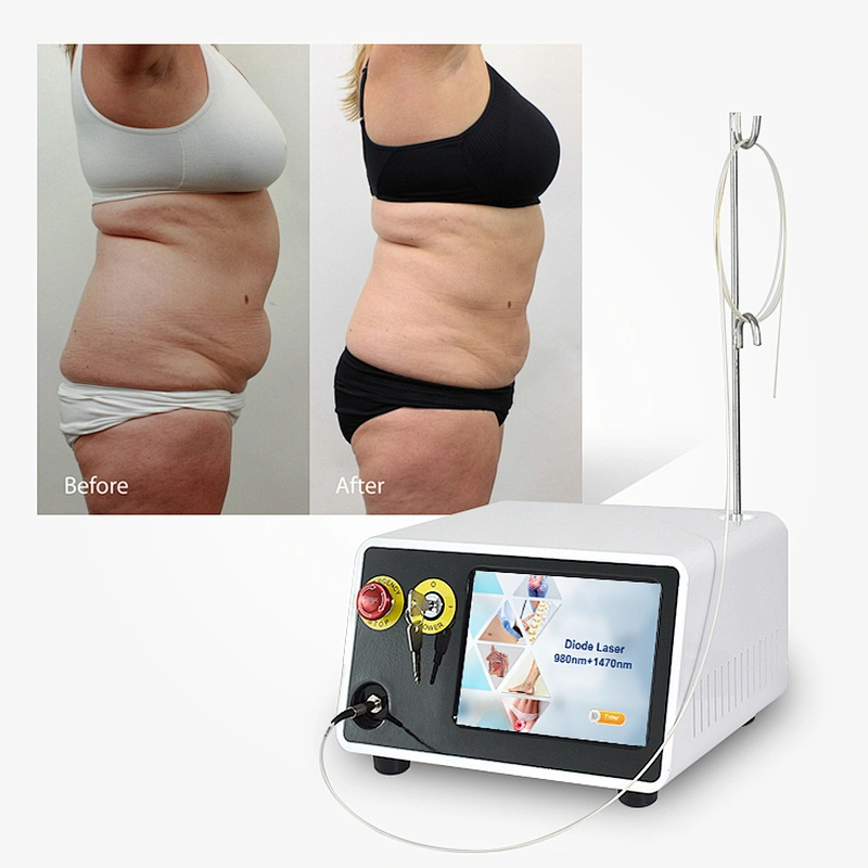 Surgery Plastic 980nm 1470nm 30W 17W Laser Endoskin Laser Lipolysis Machine