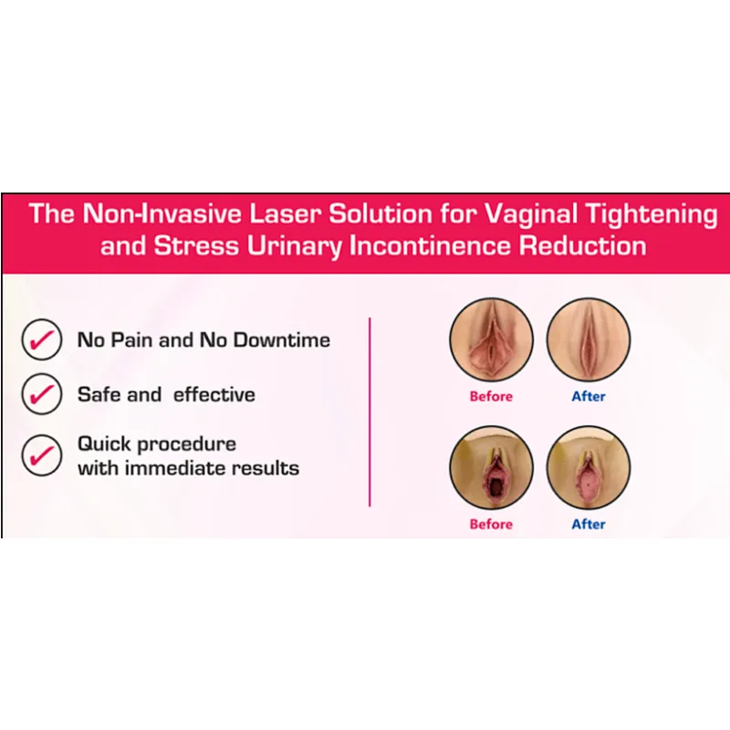 Dermatology Gynecology Laser Machine for Skin Rejuvenation Scar Removal Vagina Tightening